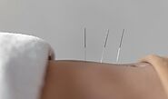 Acupuncture Surrey BC | Effective Acupuncture Therapy in Cloverdale