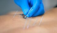 Dry Needling Surrey BC | Expert Dry Needling Therapy in Cloverdale