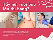 Tẩy nốt ruồi bằng laser bao lâu thì bong vảy?