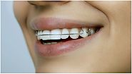 Dental Care Tips for Teeth while wearing braces
