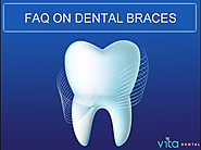 FAQ: Care for Teeth while wearing braces