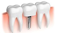 Before and After Caring Tips for Dental Implants Treatment