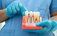 Markham Dental Implants | Restore Your Smile with Lasting Quality