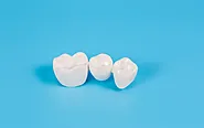 Dental Crowns in Markham for Durable Tooth Restoration