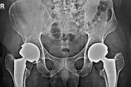 Total Hip Replacement Surgery in Delhi | Dr. Anant Kumar Tiwari – @total-hip-replacement-surgery on Tumblr