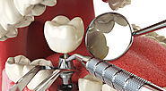 Why Dental Implants Are a Popular Choice for Smile Restoration