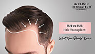 FUT vs FUE Hair Transplant: What You Should Know - Clinic Dermatech