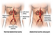 Some Useful Tips to Avoid Aneurysm