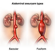 Signs of Abdominal Aortic Aneurysms That You Shouldn’t Ignore