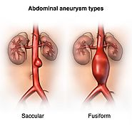 The Prevention and Cure of Abdominal Aortic Aneurysm (AAA)