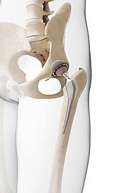 Hip Implant Failure And Product Liability Litigation - A Continuing Saga