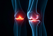 When Do You Need Knee Replacement? Signs & Symptoms to Watch For