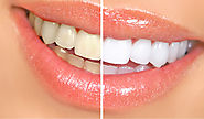 Is teeth whitening treatment from a dentist safe?
