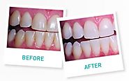 How much whiter will be teeth be after treatment