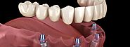 A Complete Guide to Getting Dental Implants in Melbourne