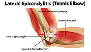 Elbow Pain Relief: Causes, Symptoms, and Lasting Osteopathy Treatments