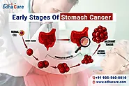 Fazat e hershme të kancerit të stomakut - simptomat dhe shkaqet