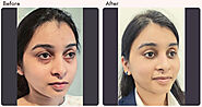 Blepharoplasty eyelid surgery in Delhi - Dr Rajat Gupta