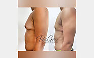 Will I Develop Loose Skin After Gynecomastia Surgery?