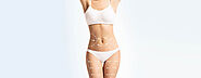 Procedure of Liposuction Surgery in Delhi