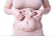 Liposuction Surgery Cost in delhi - Dr Rajat Gupta