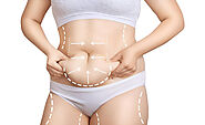 Liposuction Surgery Cost in Delhi - Dr Rajat Gupta