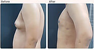 gynecomastia surgeon in Delhi - Dr Rajat Gupta