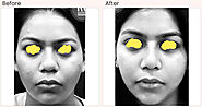 Buccal Pad Fat Removal Cost In Delhi _ Dr Rajat Gupta