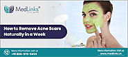 How to Remove Acne Scars Naturally in a Week - Medlinks Look Good