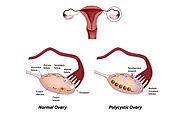 Best Age to Get Pregnant with PCOS