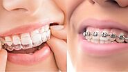 Discover the Best Aligners in Mumbai for a Perfect Smile