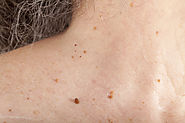 What are skin tags - How do they occur?