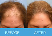 FUE Hair Transplant for Women in Bangalore and Mumbai | Follicular Unit Extraction
