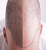 Things That You Need to Know About Hair Transplant Surgery
