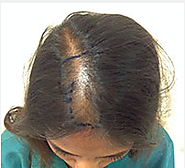 Hair Transplant Surgery for Women | Female Pattern Baldness Treatment