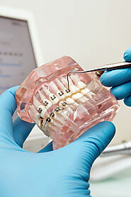 Teeth Braces In Abu Dhabi | Best Dental Braces Abu Dhabi