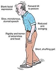 Parkinson's disease