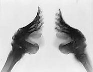 X-Ray of bound feet