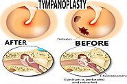 Veekay Clinic – Trusted ENT Clinic for Tympanoplasty in Vasant Kunj