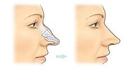 Top ENT Specialists in Vasant Kunj Offering Expert Rhinoplasty