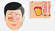 Balloon Sinuplasty: Safe, Quick, and Comfortable Sinus Relief