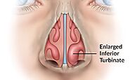 Expert ENT Specialists Offering Turbinoplasty in Vasant Kunj
