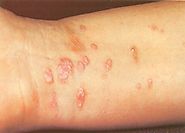 Lichen Planus Treatment by Natural Skin Care Products - Herbal Care Products Blog