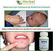 Natural Herbal Treatment for Sebaceous Cyst and Symptoms, Causes - Herbal Care Products Blog