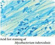 Acid fast staining of Mycobacterium tuberculosis