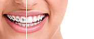 Invisalign in Kanata: The Modern Solution for Straighter Teeth : centrumdentalca — LiveJournal