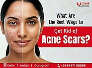 What Are the Best Ways to Get Rid of Acne Scars? - Dermatologist in Delhi | Skin Specialist in Delhi