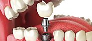 How Dental Implants Keep Your Other Teeth Healthier | Studio City Dental Center