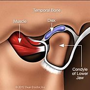 Temporo mandibular Disorders (TMD) | Studio City Dental Center