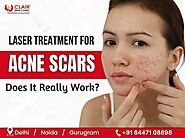 Laser Treatment for Acne Scars: Does It Really Work? - Dermatologist in Delhi | Skin Specialist in Delhi